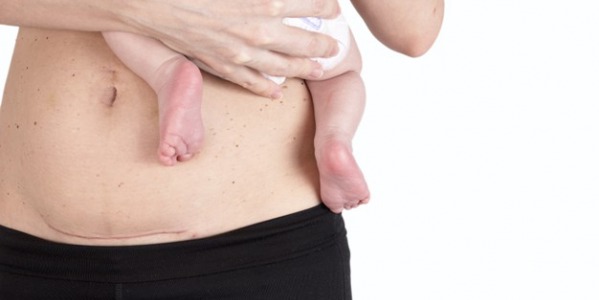 TOUT CE QU’IL FAUT SAVOIR SUR L’ACCOUCHEMENT PAR CÉSARIENNE